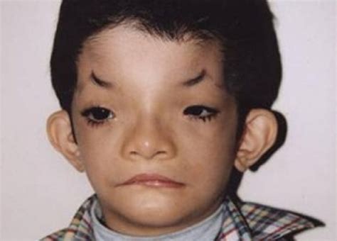 aabbccddee is a rare genetic disorder